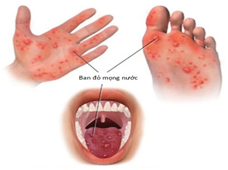Các nốt ban đỏ mọng nước trong bệnh TCM.