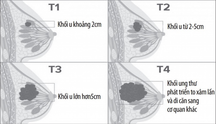 Ung thư vú ở giai đoạn sớm có thể chữa khỏi gần như  100%.
