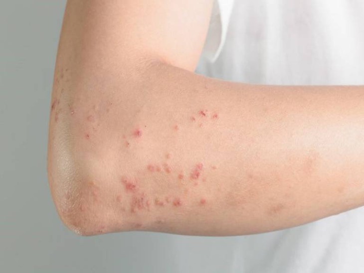 Nhận biết sớm nhiễm giun sán