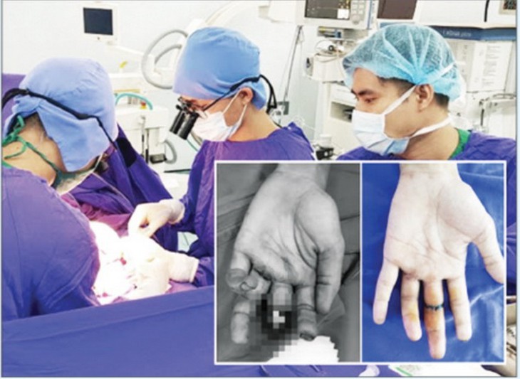 Nhiều trường hợp bị đứt ngón tay được nối thành công.