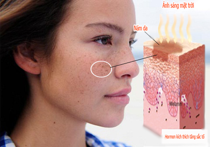 Nám da - trường hợp điển hình rối loạn sắc tố da.