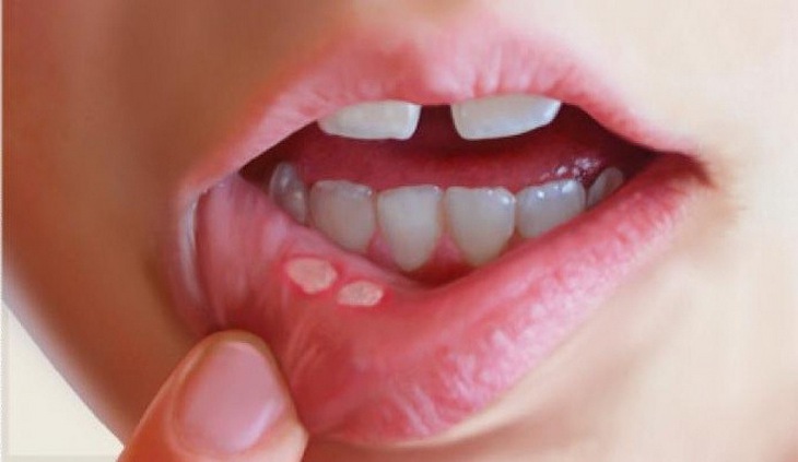 Hình ảnh loét niêm mạc miệng.
