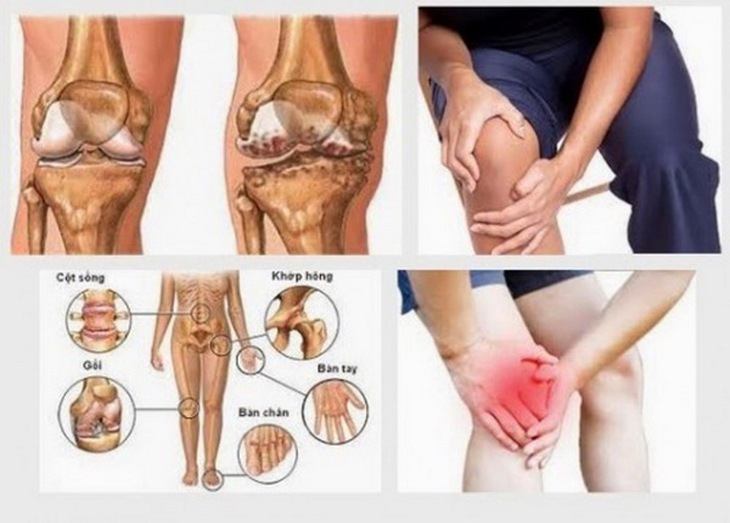 Bệnh cứng khớp nếu không điều trị sớm sẽ dẫn đến biến chứng nguy hiểm