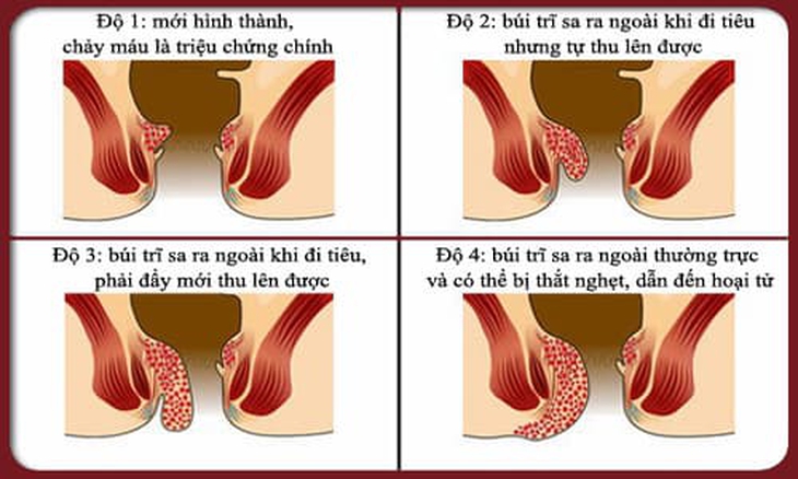 4 cấp độ của bệnh trĩ.