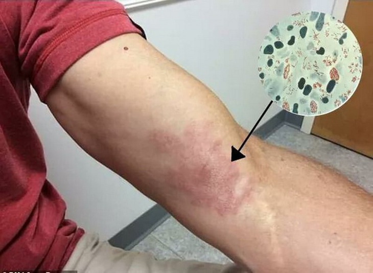 Từ ca mắc phong thể nhiều vi khuẩn giống Lupus ban đỏ Không mất cảnh giác với bệnh phong