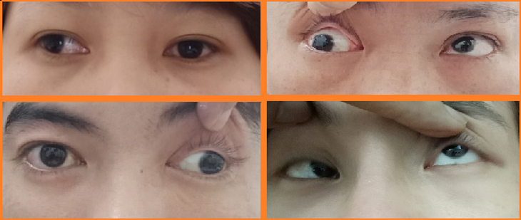 Phòng ngừa và điều trị lác mắt