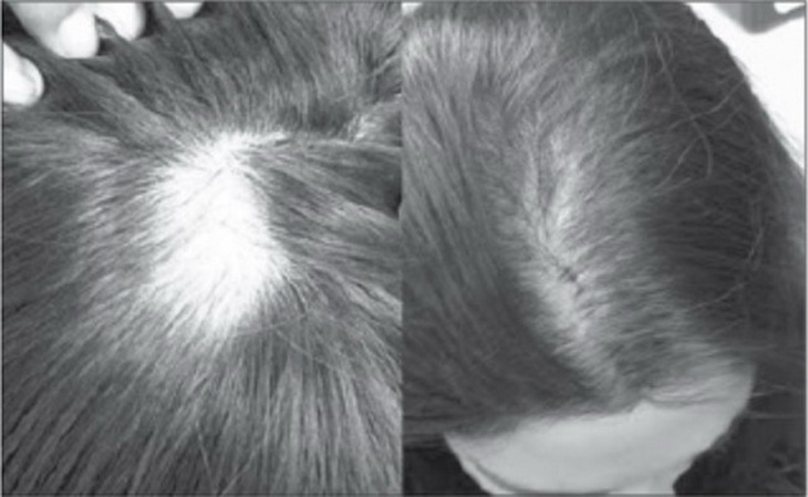 Thuốc tránh thai có chứa nội tiết tố androgen nên với những người nhạy cảm với androgen có thể bị rụng tóc.
