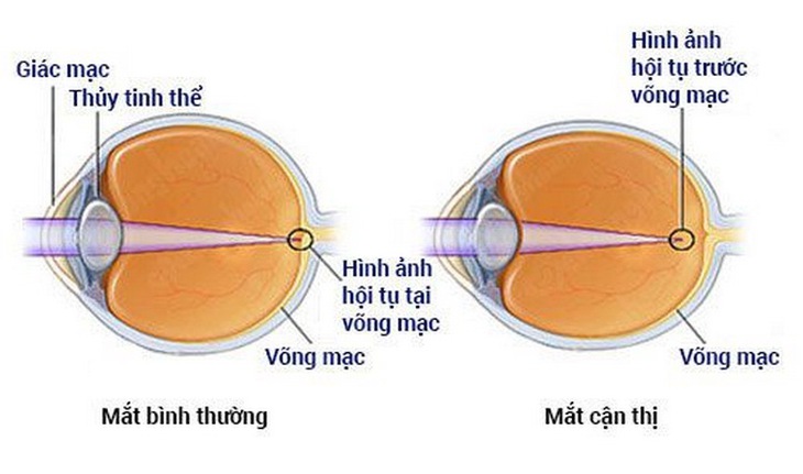 Mắt bình thường và mắt cận thị.