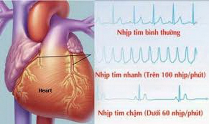 Không phải ai bị rối loạn nhịp tim cũng phải dùng thuốc.
