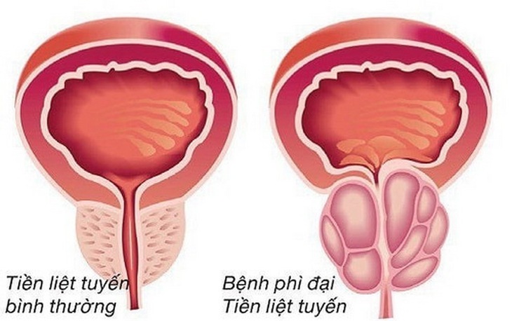 Hình ảnh chụp cộng hưởng từ của bệnh nhân bị phì đại tiền liệt tuyến chọn lựa phương pháp nút mạch.