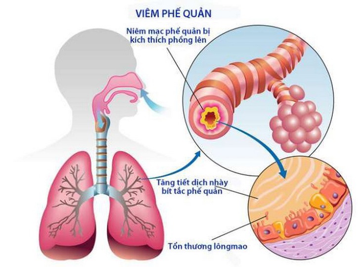 Viêm phế quản là 1 nguyên nhân gây ho.