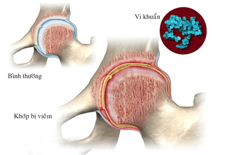 Hình ảnh khớp bình thường và khớp bị viêm.
