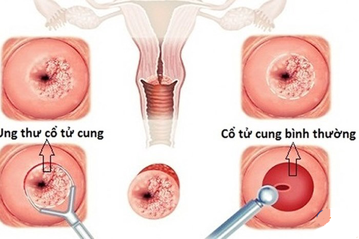 Ung thư cổ tử cung có thể chữa khỏi nếu phát hiện sớm.
