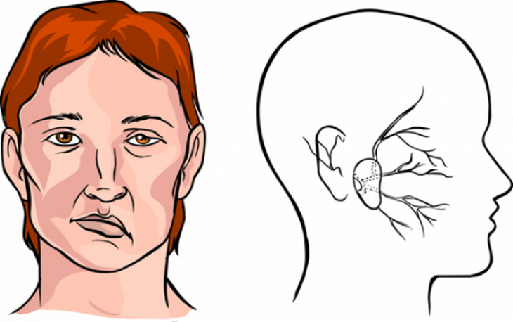 Liệt mặt ảnh hưởng đến sức khỏe, gây khó khăn trong sinh hoạt.