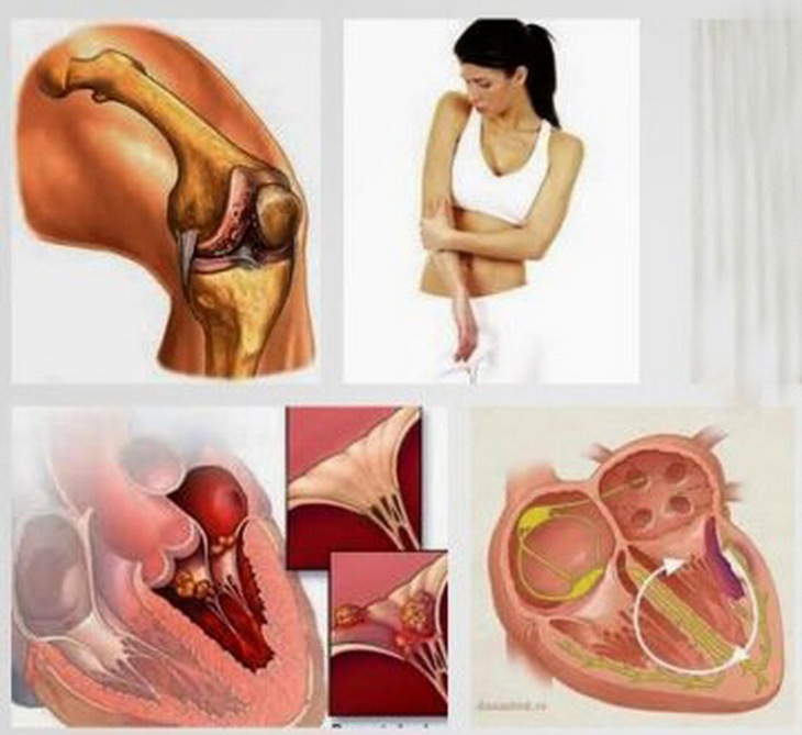 Thấp khớp cấp gây tổn thương khớp và viêm các bộ phận của tim.