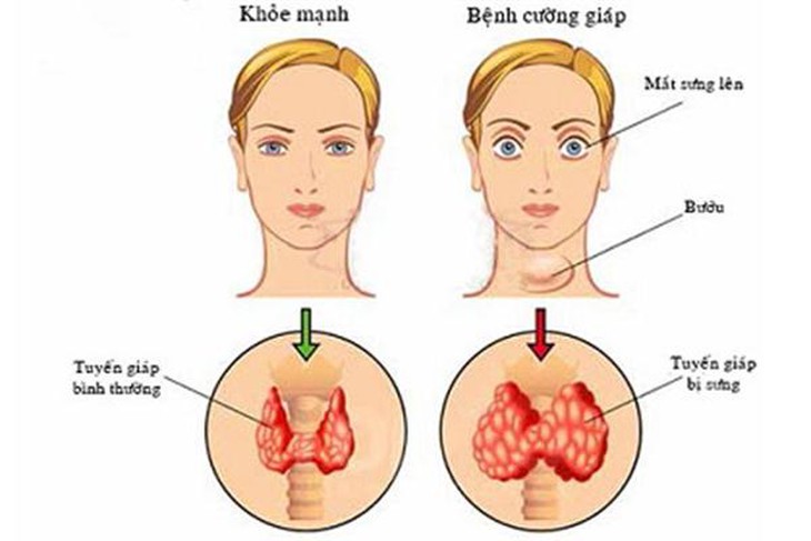 Biểu hiện của bệnh cường giáp.