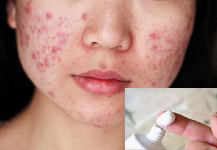 Lạm dụng thuốc bôi trị mụn chứa corticoid sẽ càng làm mụn nổi nhiều hơn.