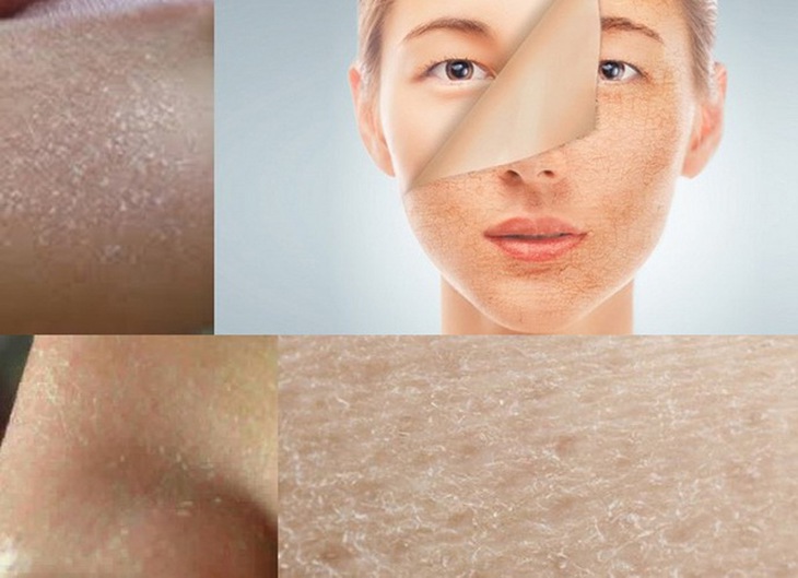 Tăng cường dưỡng ẩm giúp da bớt khô trong những ngày đông lạnh giá.
