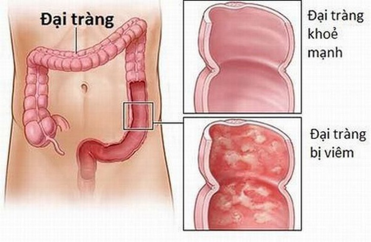 Hội chứng ruột kích thích.