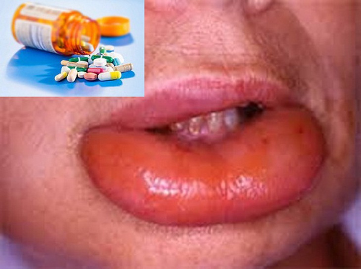 Phù Quinck là một dị ứng thuốc nguy hiểm khi dùng kháng sinh.