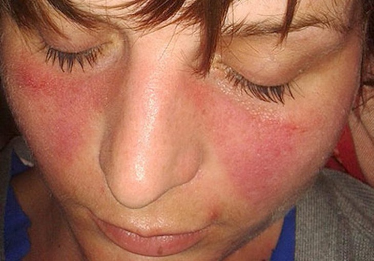 Hình ảnh lupus ban đỏ.