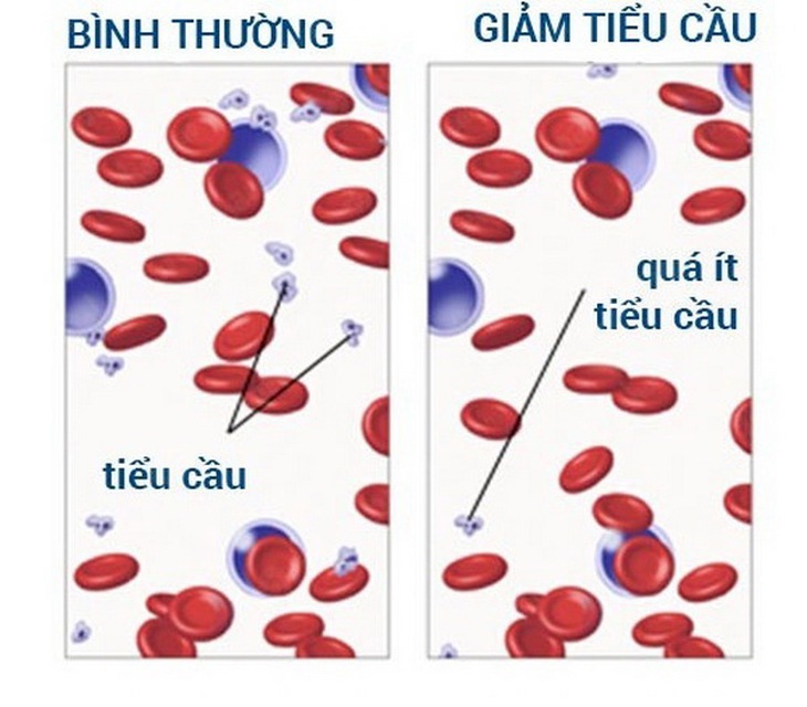 Xuất huyết giảm tiều cầu vô căn gây những vết bầm tím dưới da.