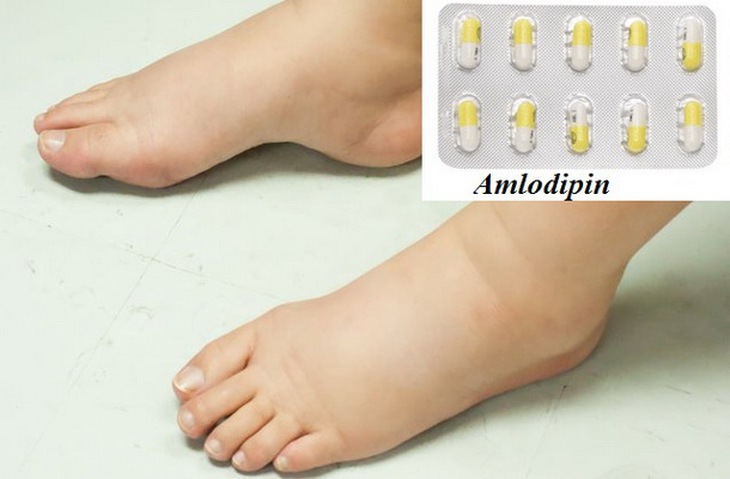 Phù chân do thuốc hạ huyết áp: Tác dụng không mong muốn thường gặp