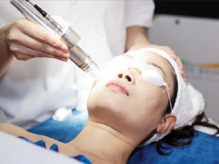 Điều trị sẹo bằng lasez.