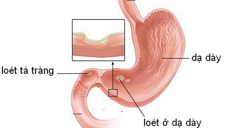 Loét dạ dày - tá tràng là một bất lợi khi dùng thuốc nhóm NSAID.