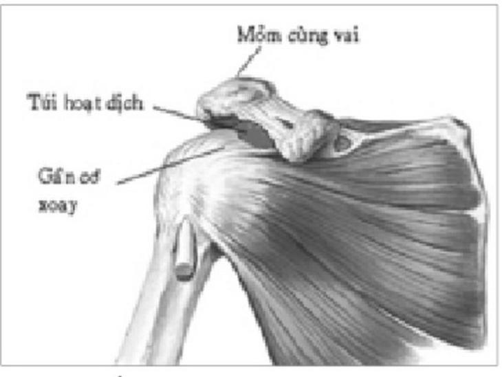 Hội chứng chèn ép dưới mỏm cùng vai là một nguyên nhân gây đau quanh vai.