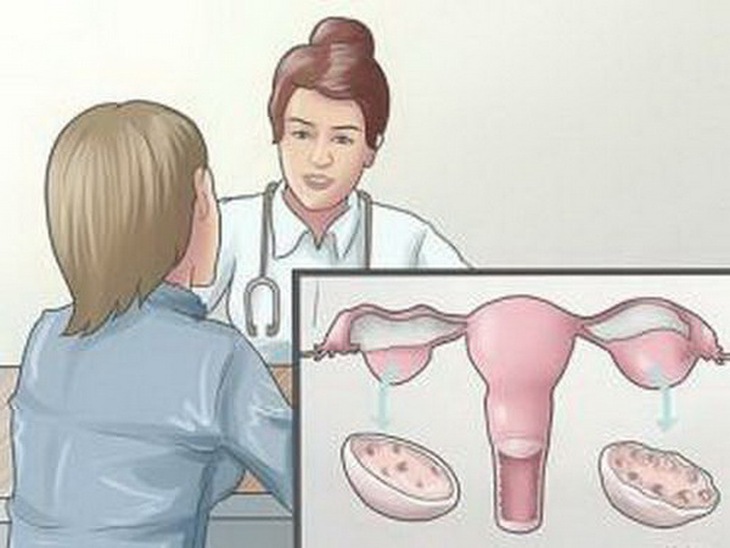Cách phân biệt u nang buồng trứng lành tính và u nang bệnh lý - Ảnh 2.
