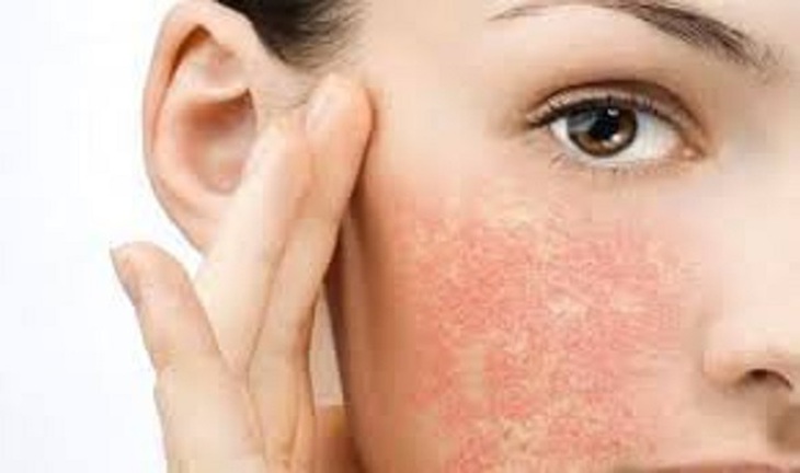 Từng mảng nổi hồng ban là tình trạng viêm da do dị ứng.