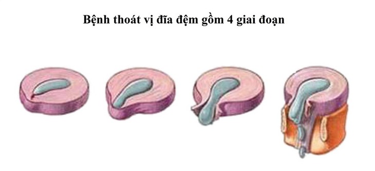 Các giai đoạn của phình đĩa đệm cột sống.