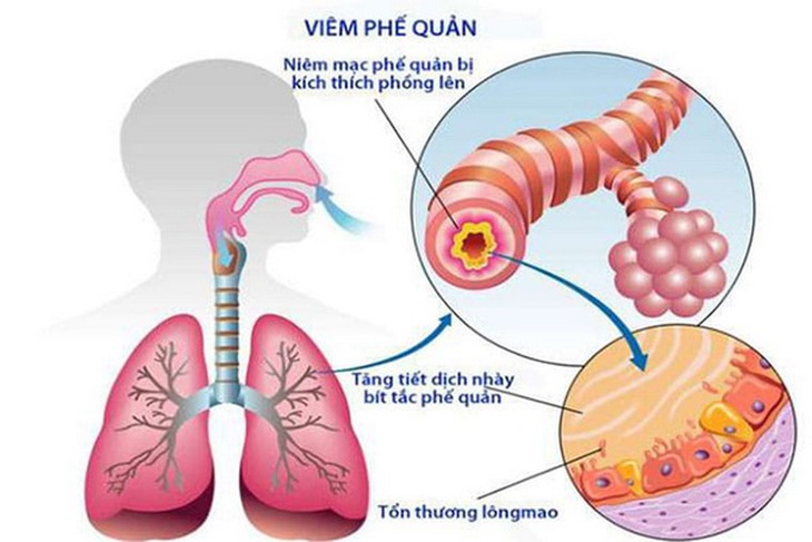 Bệnh viêm phế quản cấp nếu không được điều trị sớm và dứt điểm sẽ gây ra nhiều biến chứng nguy hiểm.