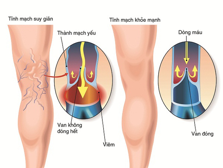 Hình ảnh suy giãn tĩnh mạch chân.