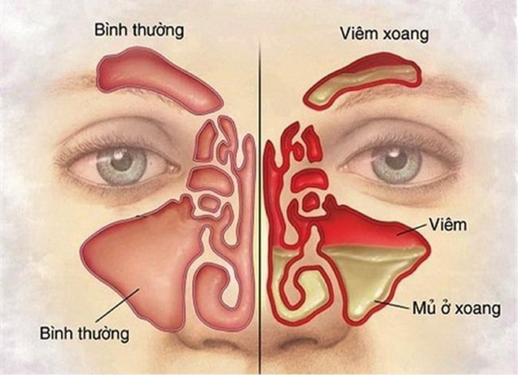 Dùng thuốc khi bị viêm mũi xoang
