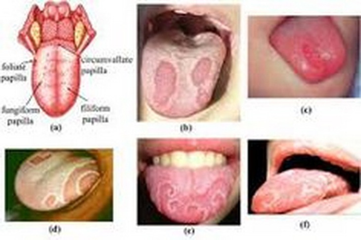 Biểu hiện của viêm lưỡi bản đồ.