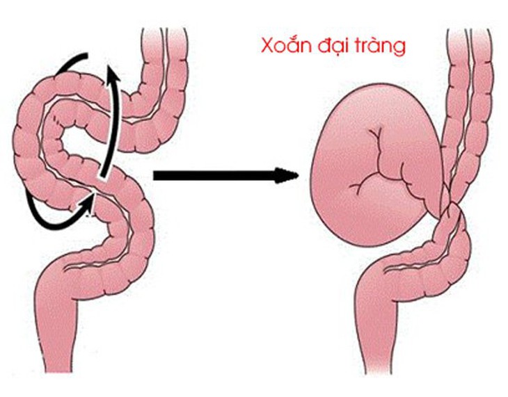 Hình ảnh xoắn đại tràng.