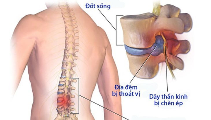 Đau lưng do thoát vị đĩa đệm.