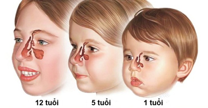 Trẻ em có bị viêm xoang?