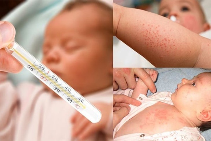 Chăm sóc trẻ sốt phát ban đúng cách tại nhà