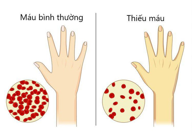 Cần đi khám để xác định tình trạng thiếu máu.