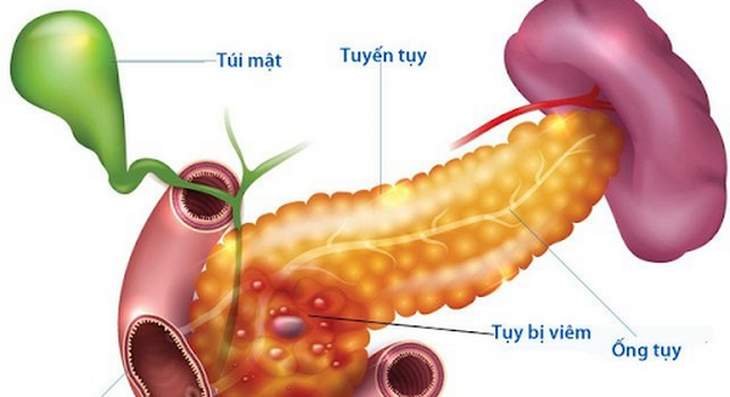 Nghiện rượu nặng và lâu dài là nguyên nhân phổ biến nhất gây viêm tụy mạn tính.