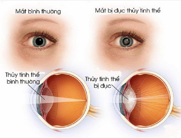 Đục thủy tinh thể - một nguyên nhân gây mờ mắt.