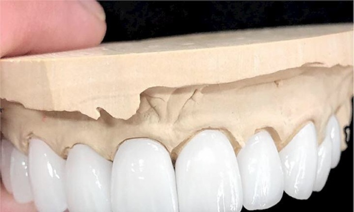 Khắc phục hôi miệng do bọc răng giả