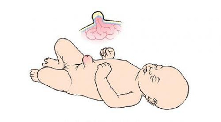 Nhận biết thoát vị rốn ở trẻ