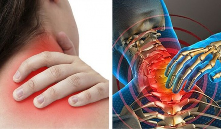 6 nguyên nhân hàng đầu gây đau vùng cổ
