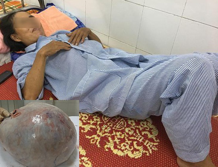 Bệnh nhân C. sau phẫu thuật cắt khối u nặng 10kg trong ổ bụng (ảnh nhỏ).