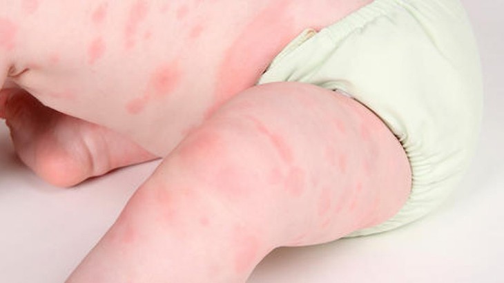 Dấu hiệu và cách chữa trị viêm da dị ứng