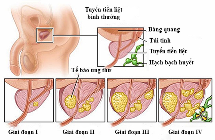 tien liet tuyen, cac giai doan cua ung thu tien liet tuyen